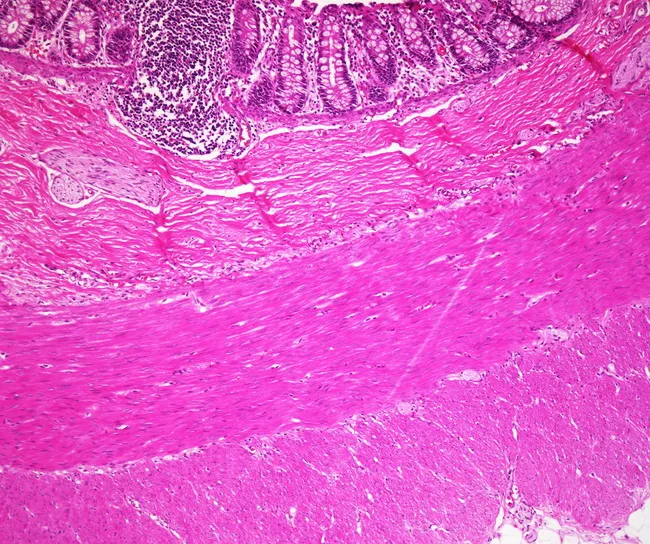 Hirschsprung Disease : Microscopic