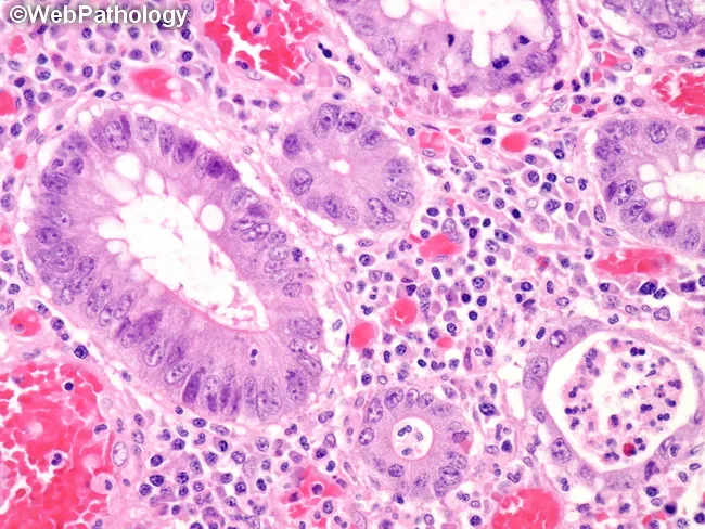Ulcerative Colitis