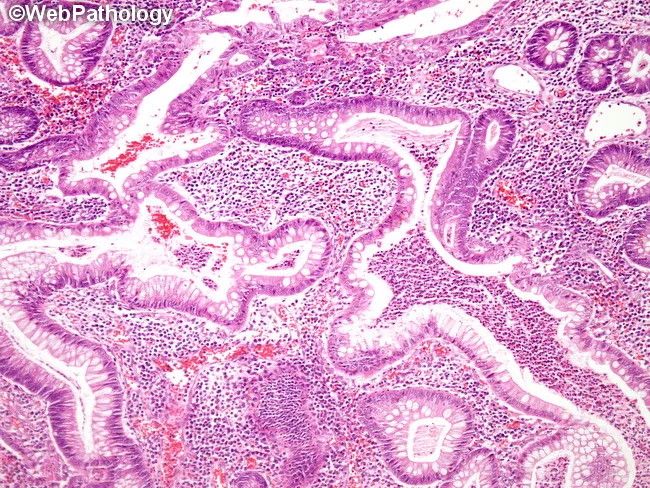 Ulcerative Colitis