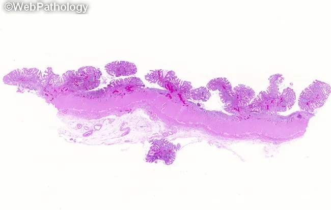 Ulcerative Colitis