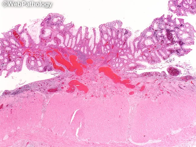 Ulcerative Colitis
