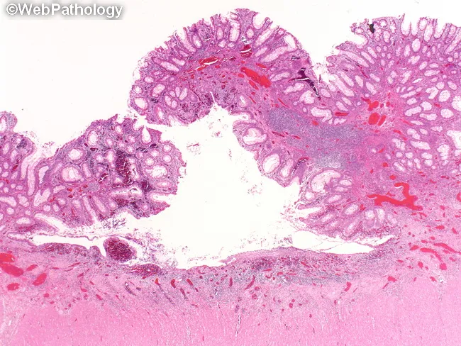 Ulcerative Colitis