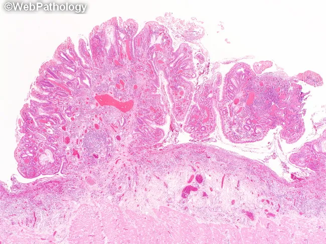 Ulcerative Colitis