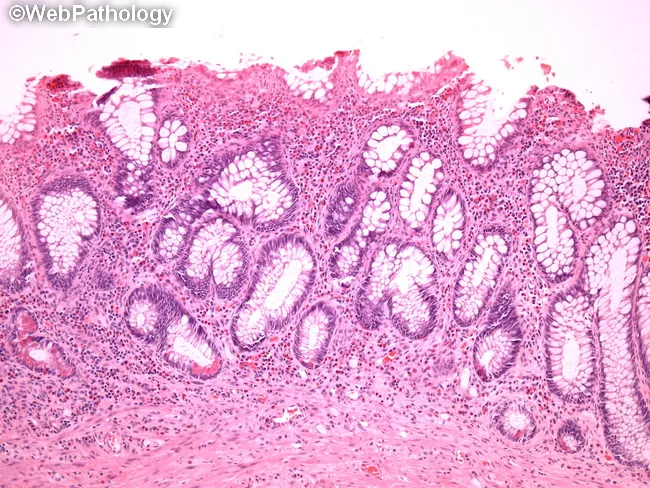 Ulcerative Colitis