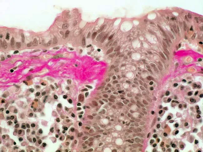 Collagenous Colitis : van Gieson