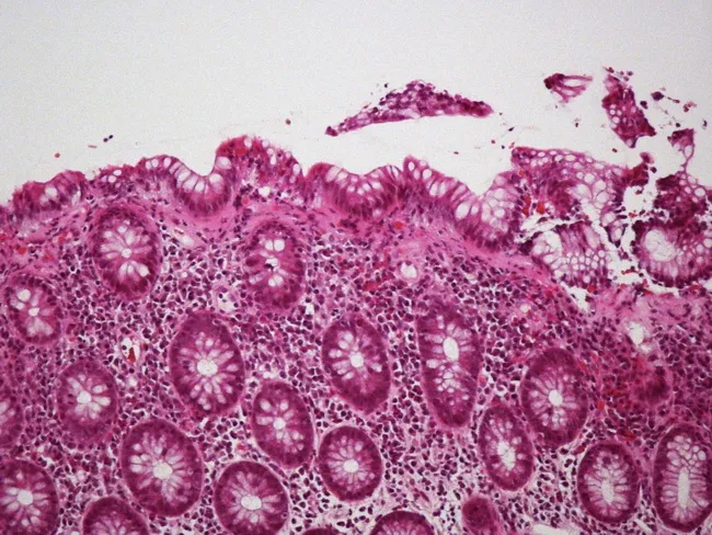 Collagenous Colitis : Pathogenesis