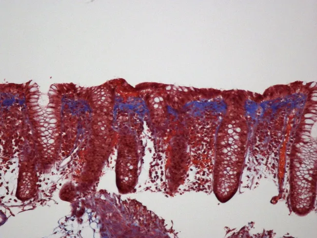 Collagenous Colitis : Treatment