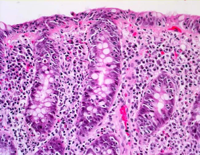 Lymphocytic Colitis : Intro & Clinical