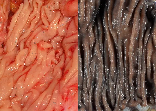 melanotic mucosa in colon icd 10 Melanosis Coli