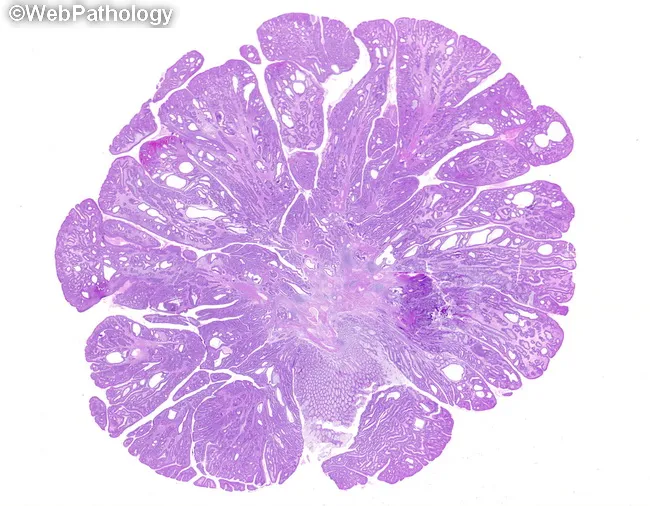 Juvenile Polyp : Microscopic