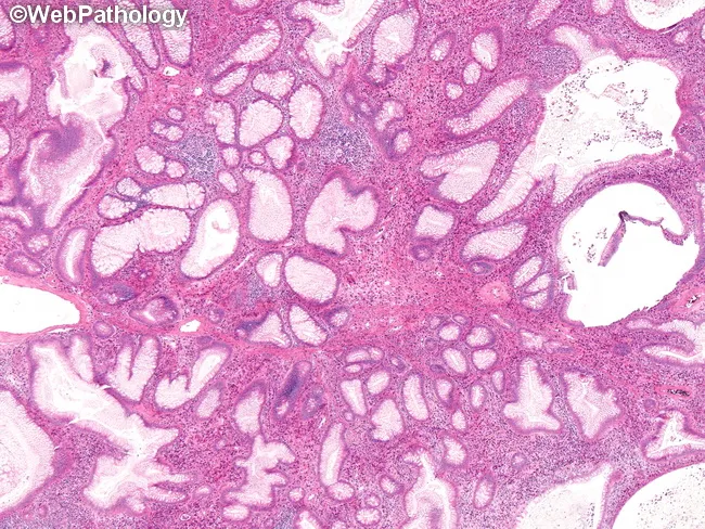 Juvenile Polyp : Microscopic