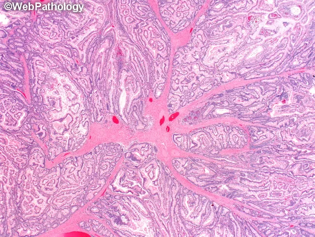 Peutz-Jeghers Polyps : Microscopic