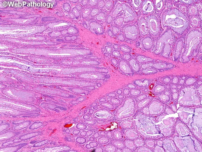 Peutz-Jeghers Polyps : Microscopic