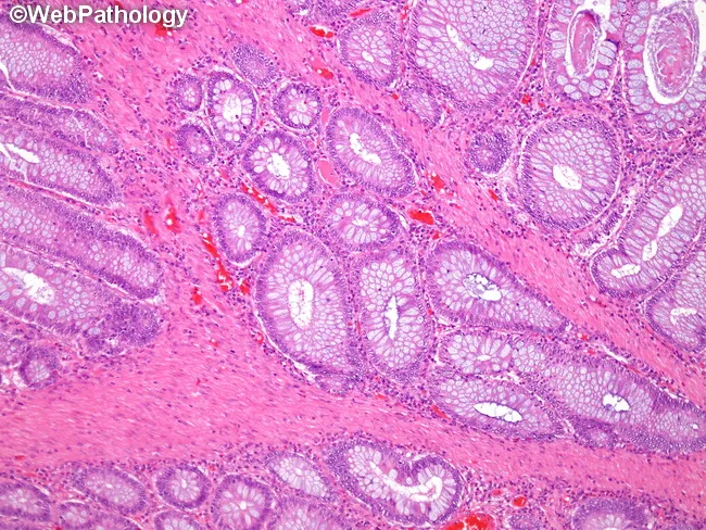 Peutz-Jeghers Polyps : Microscopic