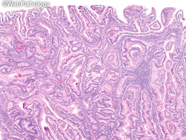 Peutz-Jeghers Polyps : Microscopic