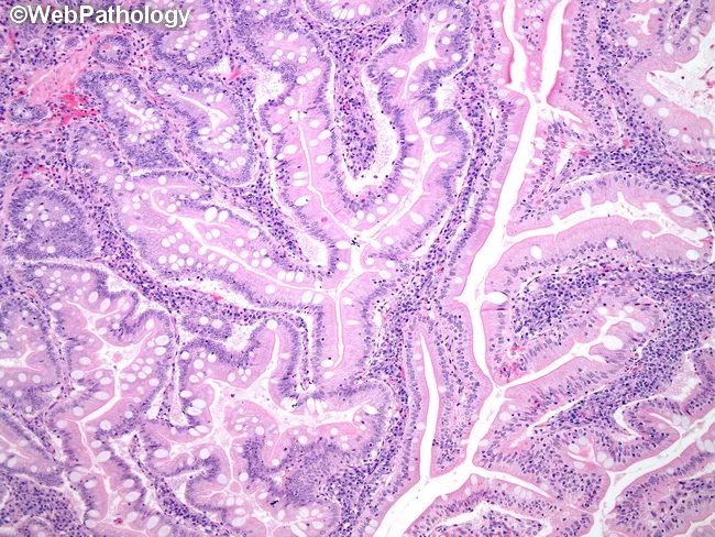 Peutz-Jeghers Polyps : Microscopic