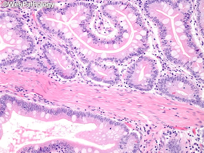 Peutz-Jeghers Polyps : Microscopic