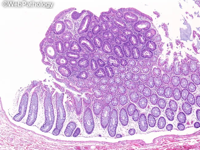 Tubular Adenoma : Histology