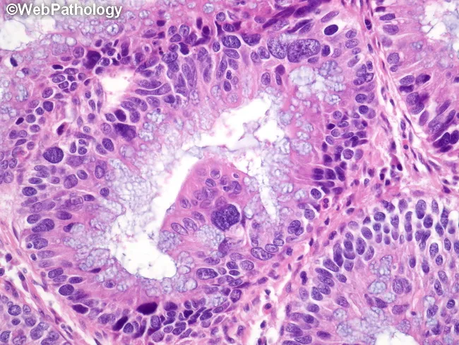 Tubuläres Adenom Mit Geringgradiger Intraepithelialer Neoplasie www.webpathology.com
