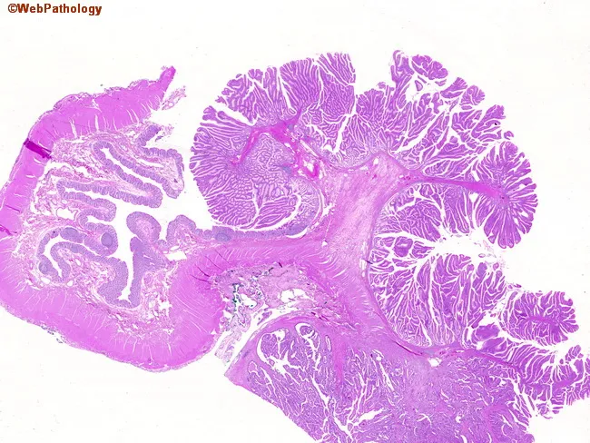 Invasive CA in a Polyp