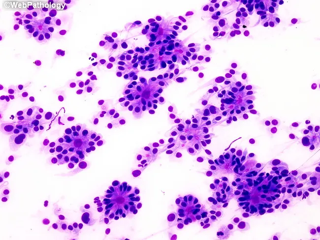 Ependymoma : True Rosettes