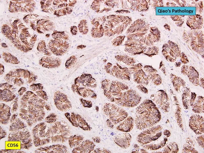 Well-differentiated Neuroendocrine Tumor : CD56