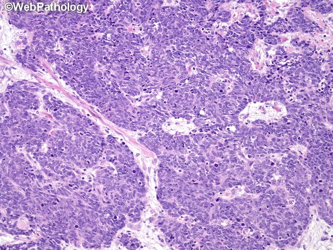 Carcinome neuroendocrine péritonéal d'origine indéterminée