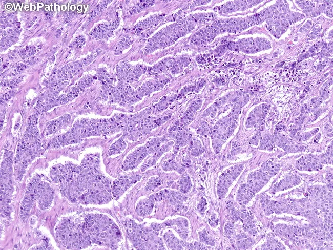 Neuroendocrine Carcinoma : Treatment & Prognosis