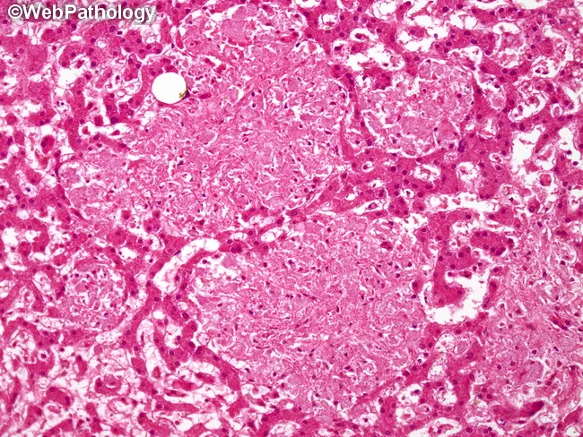 Mycobacterium Avium Intracellulare