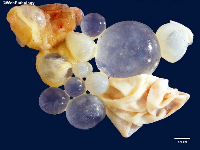 Unilocular Hydatid Cyst of Liver