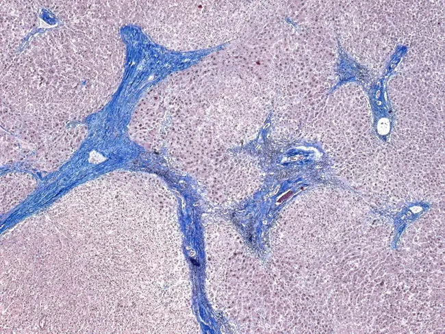 Incomplete Septal Cirrhosis : Trichrome Stain