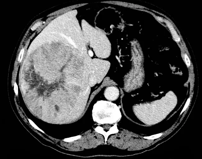 Focal Nodular Hyperplasia Central Scar Focal Nodular Hyperplasia