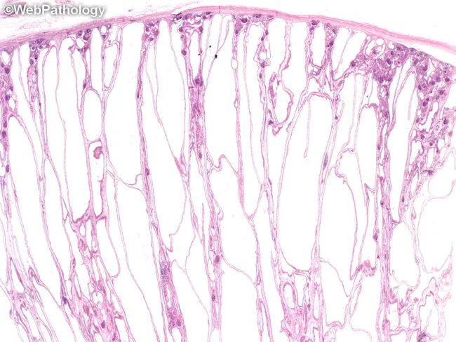 Autosomal Recessive Polycystic Kidney: Microscopic Features