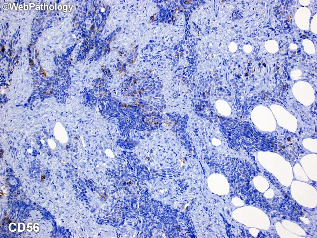 Desmoplastic Small Round Cell Tumor: CD56