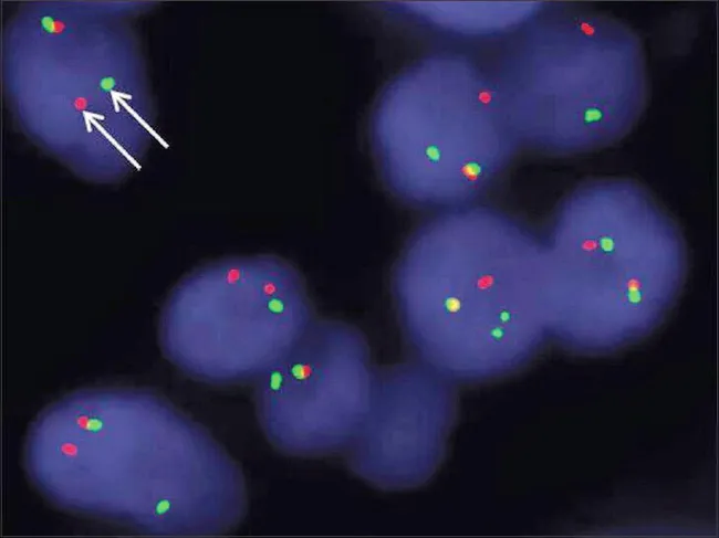 Ewing Sarcoma: Break-apart FISH for EWSR1