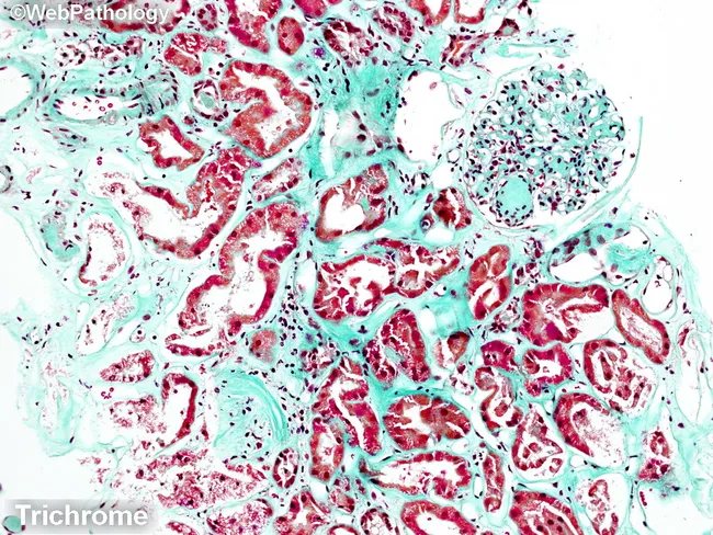 Diabetic Nephropathy: Trichrome Stain