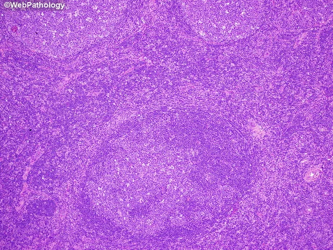 Progressively Transformed Germinal Centers: Differential Diagnosis