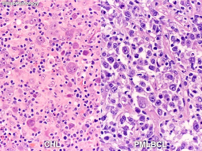 PMLBCL: Differential Diagnosis