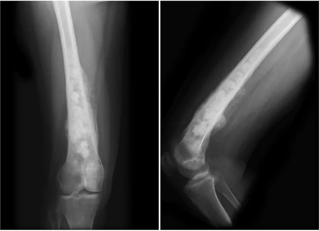 Osteosarcoma: Radiographic Features