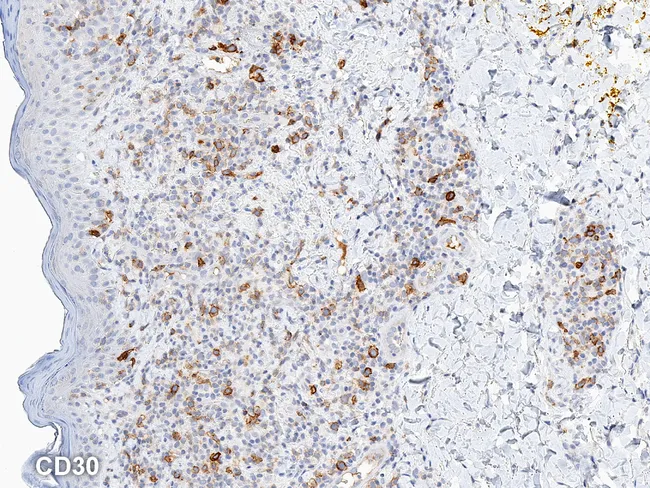 Lymphomatoid Papulosis: CD30
