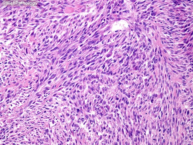 radiation-associated-osteosarcoma