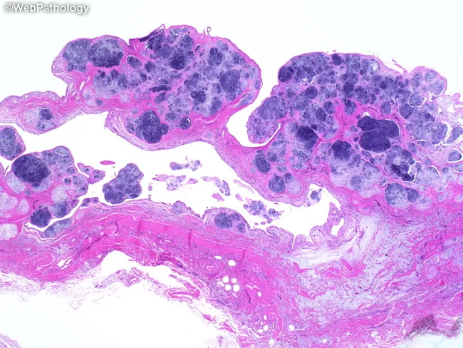 Synovial Chondromatosis: Introduction