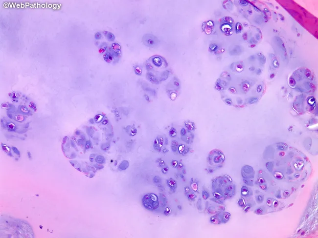 Synovial Chondromatosis: Microscopic