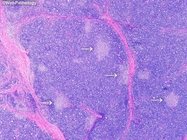 Type B1 Thymoma: Microscopic Features