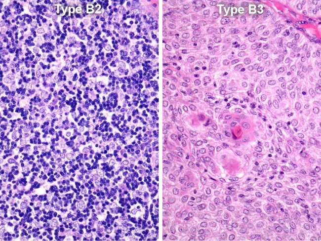 Type B3 Thymoma: Differential Diagnosis