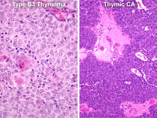 Type B3 Thymoma: Differential Diagnosis
