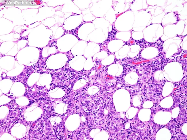 Type B3 Thymoma: Staging