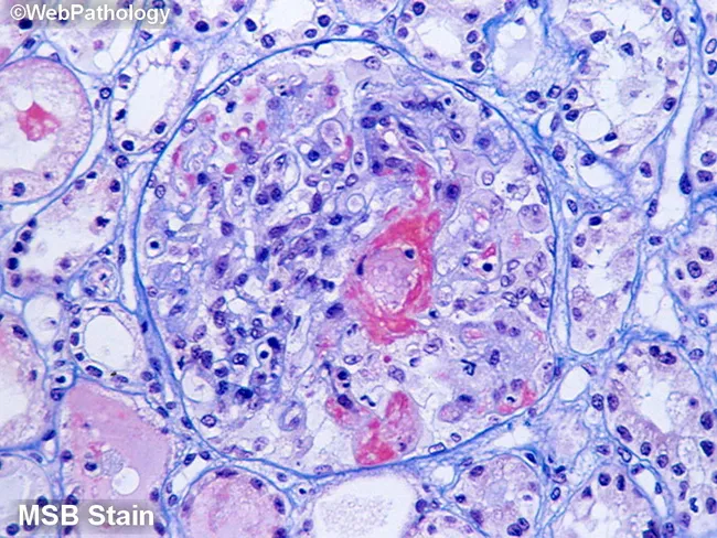 Malignant Nephrosclerosis: MSB Stain