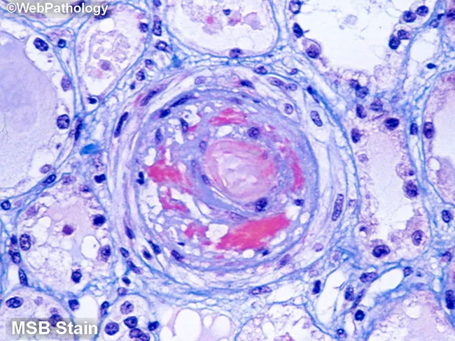 Malignant Nephrosclerosis: MSB Stain